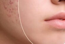 Photo of How to remove acne scars naturally: प्राकृतिक उपचार से मुंहासों के दाग-धब्बे हटाने के यह 9 सरल तरीके