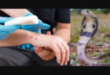 Sultanpur: Do not panic if you get bitten by a snake, get the right treatment immediately – Dr. K. Tripathi, Aastha Hospital