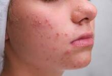 Remedies to prevent pimples: Do stale spit cure pimples and white spots? Know the opinion of doctors