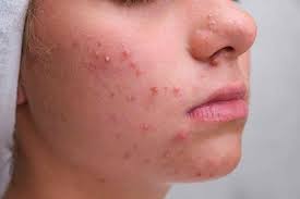 Remedies to prevent pimples: Do stale spit cure pimples and white spots? Know the opinion of doctors
