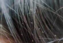 Lice Cure at Home: These 3 home remedies are the ultimate cure for lice! Dr. Hansaji Yogendra shares three effective home remedies.