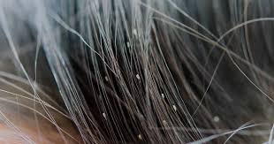 Lice Cure at Home: These 3 home remedies are the ultimate cure for lice! Dr. Hansaji Yogendra shares three effective home remedies.