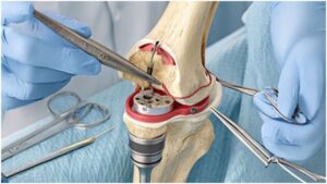 IAS-JOPP Lucknow 2026, Knee Preservation, घुटना बचाने की सर्जरी, Knee Preservation Surgery, Indian Arthroscopy Society, Lucknow Orthopaedic Society, घुटने की सर्जरी, Knee Replacement