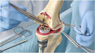 IAS-JOPP Lucknow 2026, Knee Preservation, घुटना बचाने की सर्जरी, Knee Preservation Surgery, Indian Arthroscopy Society, Lucknow Orthopaedic Society, घुटने की सर्जरी, Knee Replacement